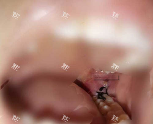 拔牙伤口缝合.jpg 拔牙伤口缝合.jpg