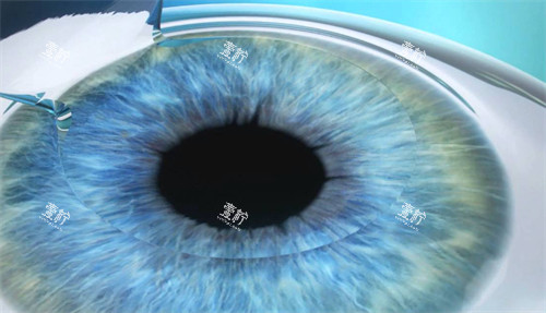 近视手术前眼睛制瓣.jpg 近视手术前眼睛制瓣.jpg