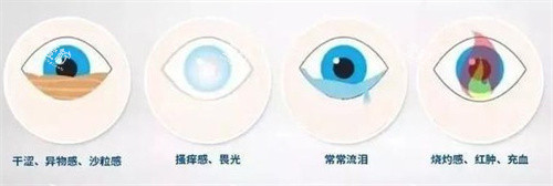 近视手术后干眼症的症状2.jpg 近视手术后干眼症的症状2.jpg