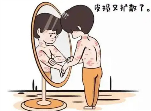 牛皮癣银屑病扩散.jpg