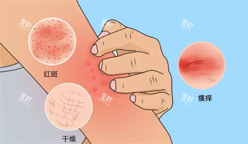 牛皮癣银屑病细节图.jpg