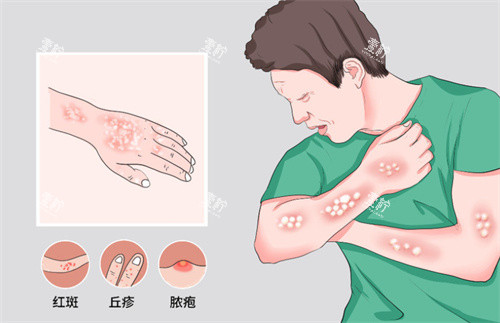 牛皮癣银屑病示意图.jpg