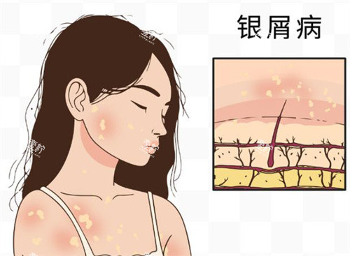 牛皮癣银屑病卡通图.jpg