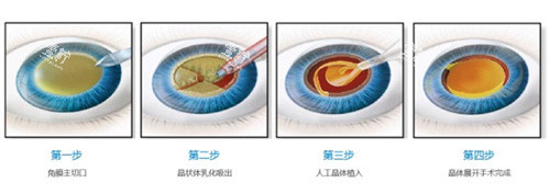 白内障手术过程.jpg