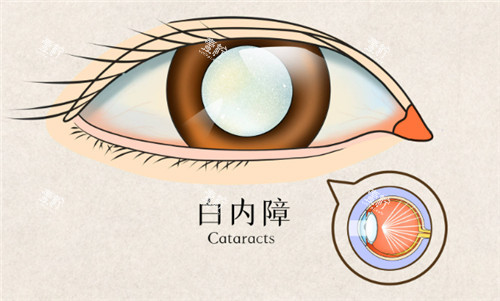 白内障眼睛表现.jpg