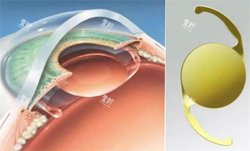 白内障人工晶体的选择.jpg