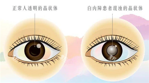 白内障和正常眼球的对比图.jpg