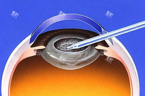 白内障手术卡通图.jpg