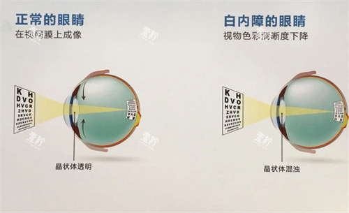 正常眼睛和白内障眼睛的对比图.jpg