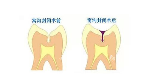 窝沟封闭后的成效.png