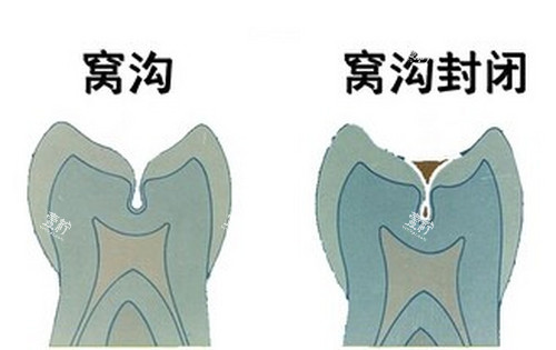 窝沟及窝沟封闭示意图.jpg