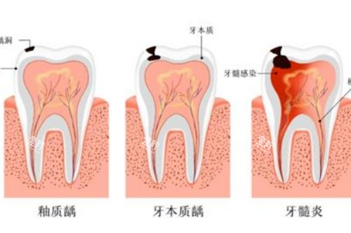 牙髓炎和其他牙齿炎症的对比.jpg 牙髓炎和其他牙齿炎症的对比.jpg