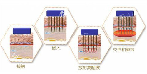 黄金微针原理解析.jpg