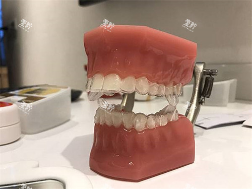 隐形牙齿矫正牙套模型.jpg