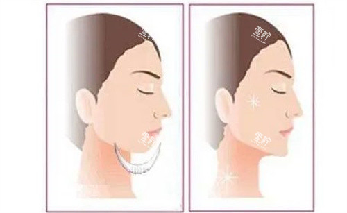 假体垫下巴.jpg