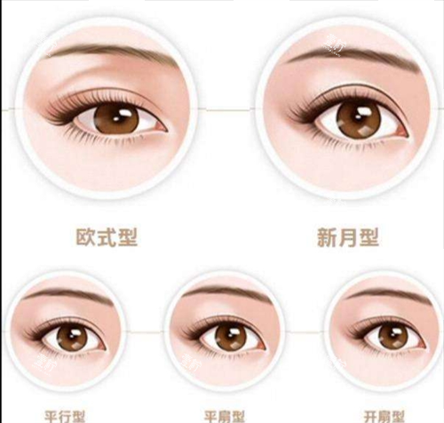 双眼皮类型图示.png
