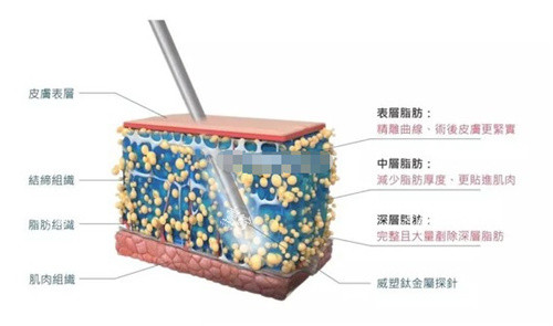 玲珑体雕吸脂.jpg