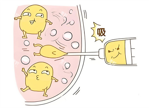 吸脂.jpg