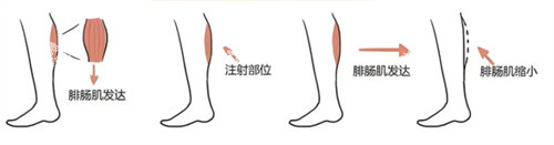 注射瘦腿过程.jpg