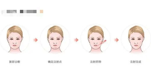 骸肌放松注射过程示意图.jpg