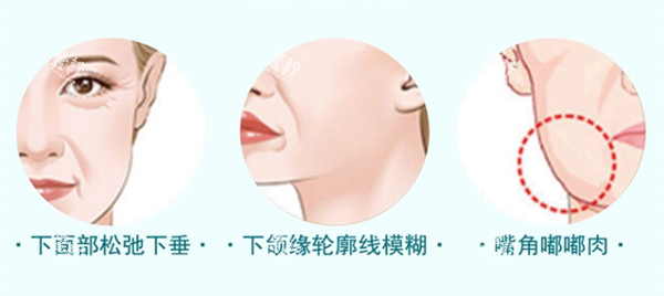适合埋线提升的情况.jpg