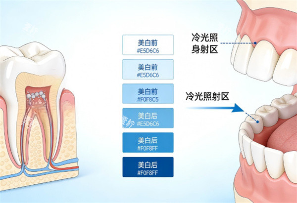牙齿冷光美白治疗示意图.jpg 牙齿冷光美白治疗示意图.jpg