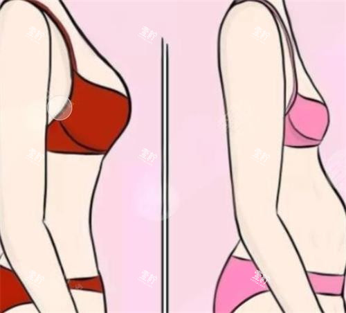 隆胸前后成效对比图.png