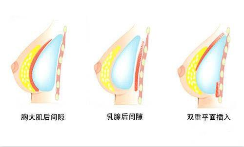 隆胸假体植入方式示意图.jpg