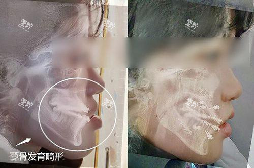 地包天正颌手术前后对比.jpg