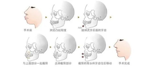 正颌手术步骤图示.JPG
