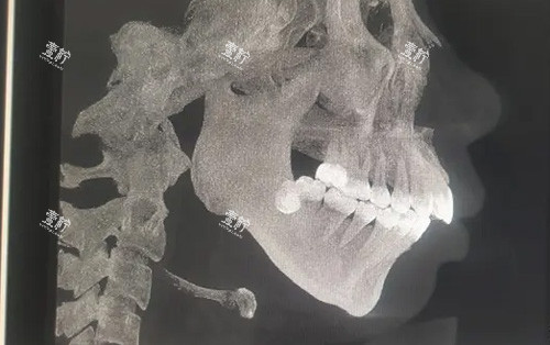 需要做正颌手术的骨骼图.jpg