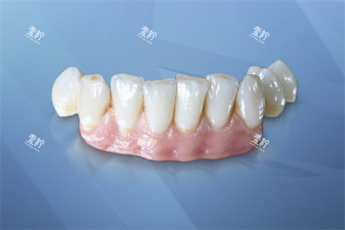威兰德Zenostar全瓷牙义齿成品.jpg 威兰德Zenostar全瓷牙义齿成品.jpg