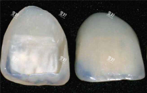 牙齿贴面成品.jpg 牙齿贴面成品.jpg