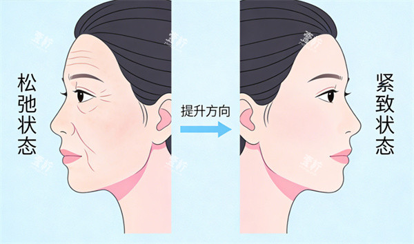 面部紧致除皱示意图.jpg 面部紧致除皱示意图.jpg