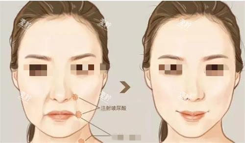 注射玻尿酸前后对比图.png