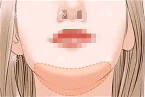 玻尿酸丰下巴部位示意图.png