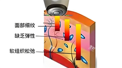 热拉提作用.jpg 热拉提作用.jpg