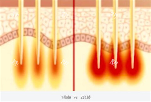黑曜双波黄金微针双波发射模式.jpg 黑曜双波黄金微针双波发射模式.jpg