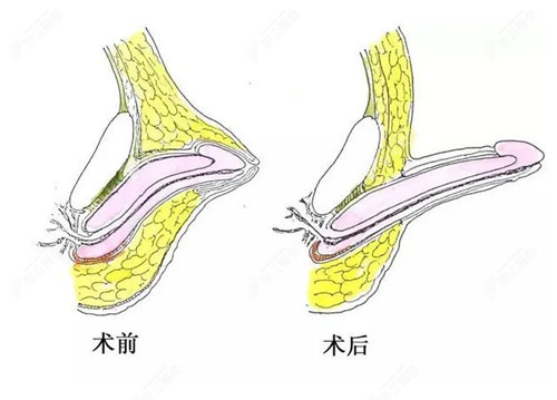 男性私密整形阴茎增长手术示意图.jpg