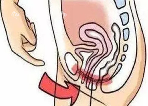 女性私密整形位置示意图.jpg