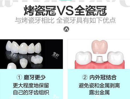 烤瓷冠全瓷冠优势对比.jpg